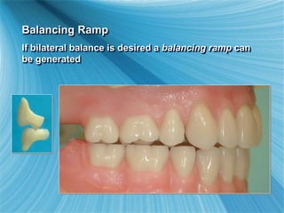 Balancing Ramp
If bilateral balance is desired a balancing ramp can
be generated
 