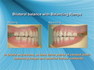 In lateral excursions, at least three points of contact (both
balancing ramps and anterior incisor contacts)
Bilateral balance with Balancing Ramps
Working Balancing
 