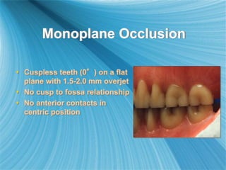 Monoplane Occlusion
 Cuspless teeth (0°) on a flat
plane with 1.5-2.0 mm overjet
 No cusp to fossa relationship
 No anterior contacts in
centric position
 