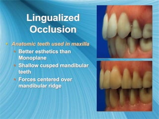 Lingualized
Occlusion
 Anatomic teeth used in maxilla
 Better esthetics than
Monoplane
 Shallow cusped mandibular
teeth
 Forces centered over
mandibular ridge
 