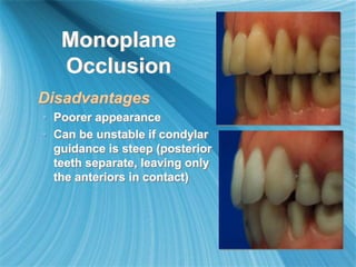 Monoplane
Occlusion
Disadvantages
• Poorer appearance
• Can be unstable if condylar
guidance is steep (posterior
teeth separate, leaving only
the anteriors in contact)
 