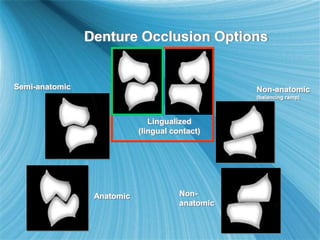Denture Occlusion Options
Anatomic
Semi-anatomic
Lingualized
(lingual contact)
Non-anatomic
(balancing ramp)
Non-
anatomic
 