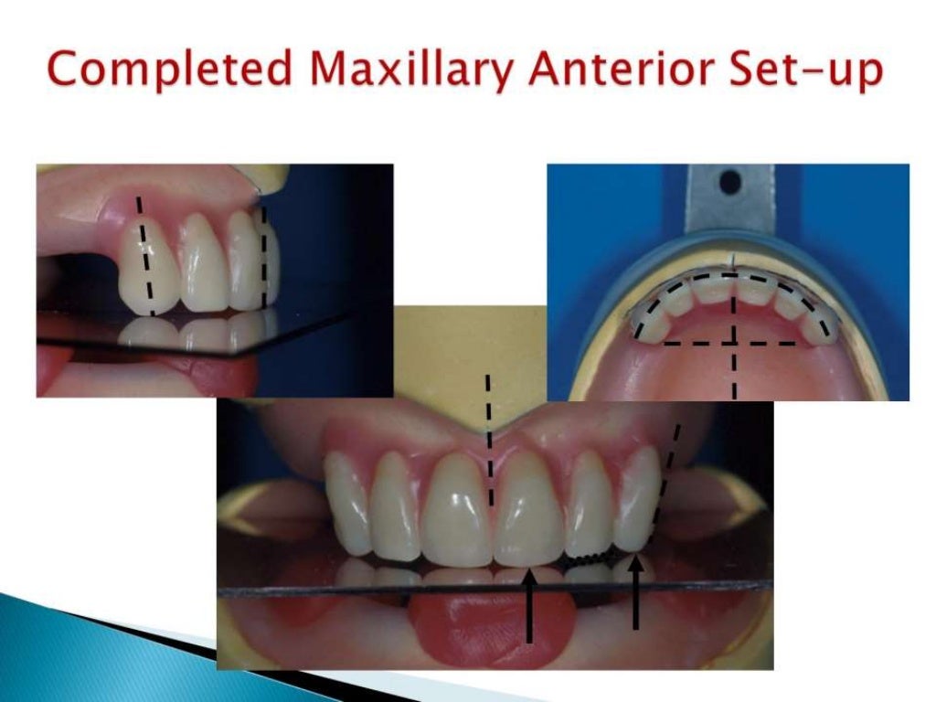 Setting maxillary posterior anatomic denture teeth cd 2nd yr