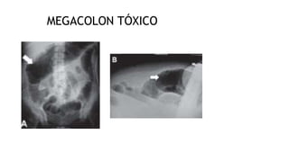 MEGACOLON TÓXICO
 