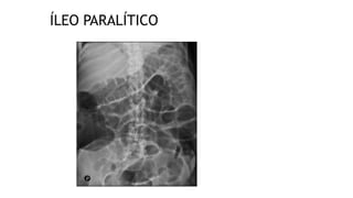 ÍLEO PARALÍTICO
 