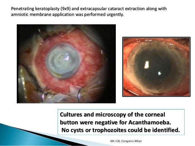 Severe acanthamoeba keratitis treated with corneal cross Severe acanthamoeba keratitis treated with corneal cross