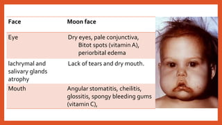 Face Moon face
Eye Dry eyes, pale conjunctiva,
Bitot spots (vitamin A),
periorbital edema
lachrymal and
salivary glands
atrophy
Lack of tears and dry mouth.
Mouth Angular stomatitis, cheilitis,
glossitis, spongy bleeding gums
(vitamin C),
 