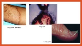 Flaky paint Dermatosis
Flag sign
Koilonychia
 