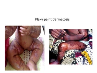 Flaky paint dermatosis 
 