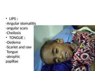 SEVERE ACUTE MALNUTRITION SEMINAR new.pptx