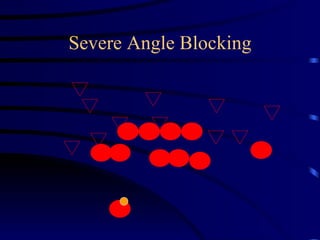 Severe Angle Blocking 