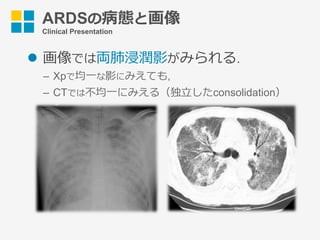 ARDSの病態と画像
Clinical Presentation
l  画像では両肺浸潤影がみられる.
–  Xpで均⼀な影にみえても,
–  CTでは不均⼀にみえる（独⽴したconsolidation）
 