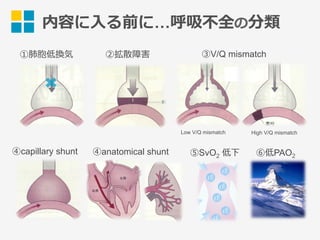 Severe ARDSの初期治療 | PPT