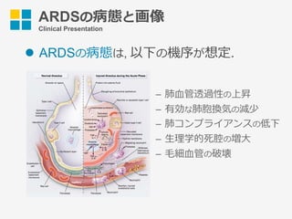 ARDSの病態と画像
Clinical Presentation
l  ARDSの病態は, 以下の機序が想定.
–  肺⾎管透過性の上昇
–  有効な肺胞換気の減少
–  肺コンプライアンスの低下
–  ⽣理学的死腔の増⼤
–  ⽑細⾎管の破壊
 