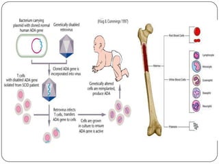 Scid Inheritance Bone Marrow Transplant Scid
