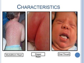 CHARACTERISTICS
Morbilliform Rash Diaper
Rash
Oral Thrush
 