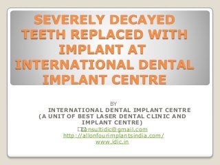 SEVERELY DECAYED
TEETH REPLACED WITH
IMPLANT AT
INTERNATIONAL DENTAL
IMPLANT CENTRE
BY
INTERNATIONAL DENTAL IMPLANT CENTRE
(A UNIT OF BEST LASER DENTAL CLINIC AND
IMPLANT CENTRE)
ž žconsultidic@gmail.com
http://allonfourimplantsindia.com/
www.idic.in
 