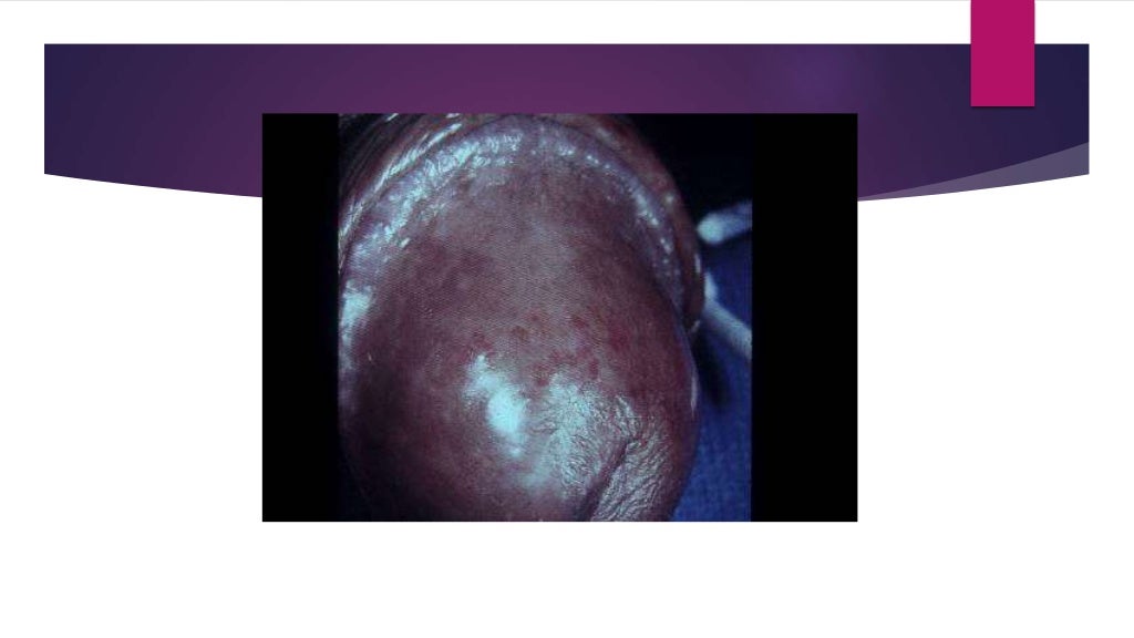 Genital Skin Lesions