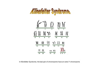 In Klinefelter Syndrome, the last pair of chromosome have an extra Y chromosome
 