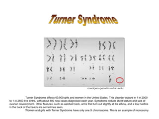 Turner Syndrome affects 60,000 girls and women in the United States. This disorder occurs in 1 in 2000
to 1 in 2500 live births, with about 800 new cases diagnosed each year. Symptoms include short stature and lack of
ovarian development. Other features, such as webbed neck, arms that turn out slightly at the elbow, and a low hairline
in the back of the heads are sometimes seen.
               Women and girls with Turner Syndrome have only one X chromosome. This is an example of monosomy.
 