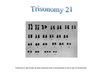 Trisonomy 21 also known as down syndrome have 3 chromosomes in the 21 pair of chromosome.
 