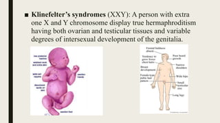 ■ Klinefelter’s syndromes (XXY): A person with extra
one X and Y chromosome display true hermaphroditism
having both ovarian and testicular tissues and variable
degrees of intersexual development of the genitalia.
 