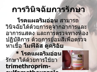 การวินิจฉัยการรักษา
      โรคแผลริมอ่อน สามารถ
วินิจฉัยได้ด้วยการดูจากอาการและ
อาการแสดง และการตรวจทางห้อง
ปฏิบัติการ ด้วยการย้อมสีเพื่อตรวจ
หาเชื้อ โมฟีลัส ดูคริอัย
     * โรคแผลริมอ่อน สามารถ
รักษาได้ด้วยการใช้ยา 
trimethroprim-
 