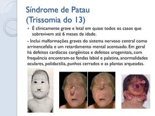 Síndrome de Patau (Trissomia do 13) 
É clinicamente grave e letal em quase todos os casos que sobrevivem até 6 meses de idade. 
- Inclui malformações graves do sistema nervoso central como arrinencefalia e um retardamento mental acentuado. Em geral há defeitos cardíacos congênitos e defeitos urogenitais, com frequência encontram-se fendas labial e palatina, anormalidades oculares, polidactilia, punhos cerrados e as plantas arqueadas.  