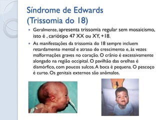 Síndrome de Edwards (Trissomia do 18) 
Geralmente, apresenta trissomia regular sem mosaicismo, isto é , cariótipo 47 XX ou XY, +18. 
As manifestações da trissomia do 18 sempre incluem retardamento mental e atraso do crescimento e, às vezes malformações graves no coração. O crânio é excessivamente alongado na região occipital. O pavilhão das orelhas é dismórfico, com poucos sulcos. A boca é pequena. O pescoço é curto. Os genitais externos são anômalos.  