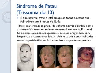 Síndrome de Edwards (Trissomia do 18) 
Geralmente, apresenta trissomia regular sem mosaicismo, isto é , cariótipo 47 XX o...
