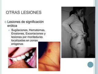 Acallar los gritos de la víctima Presión sobre el cuello – AsfixiaEstigmas ungueales en cuello, boca, nariz y resto de la cara