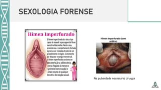 SEXOLOGIA FORENSE
Na puberdade necessário cirurgia
 