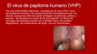 El virus de papiloma humano (VHP)
Es una enfermedad infecciosa causada por el virus VPH ( virus
del papiloma humano). Se puede transmitir principalmente por vía
sexual, aunque tan bien se puede contagiar, en piscinas, baños y
saunas. Se presenta en la piel de la zona genital en forma de
verrugas, las lesiones pueden ser a simple vista o se pueden
diagnosticar por observación de tejido con un microscopio.
 