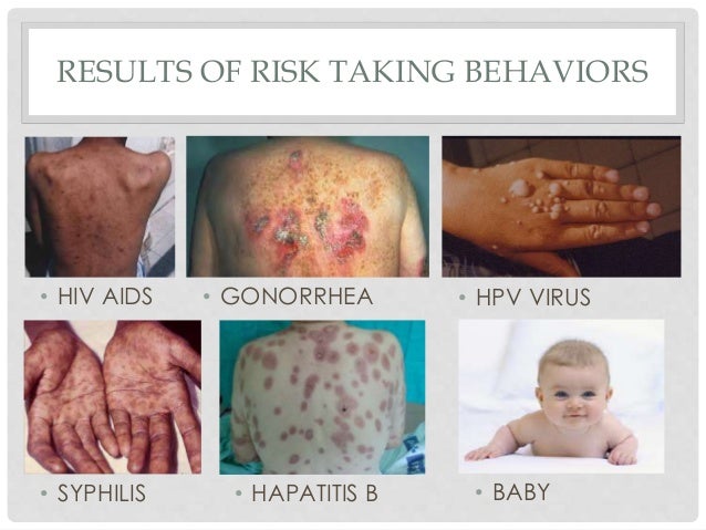 Image result for syphilis baby Image result for syphilis baby