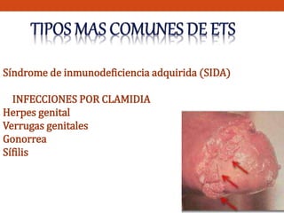 Síndrome de inmunodeficiencia adquirida (SIDA) 
INFECCIONES POR CLAMIDIA 
Herpes genital 
Verrugas genitales 
Gonorrea 
Sífilis 
 