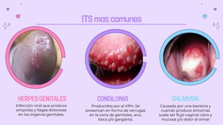 ITS mas comunes
CONDILOMAS
Producidos por el VPH. Se
presentan en forma de verrugas
en la zona de genitales, ano,
boca y/o garganta.
CHLAMYDIA
Causada por una bacteria y
cuando produce síntomas
suele ser flujo vaginal claro y
mucosa y/o dolor al orinar
HERPES GENITALES
Infección viral que produce
ampollas y llagas dolorosas
en los órganos genitales.
 