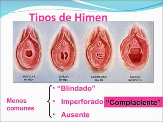 Tipos de Himen <ul><li>“ Blindado” </li></ul><ul><li>Imperforado </li></ul><ul><li>Ausente </li></ul>Menos   comunes “ Com...