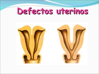 Defectos uterinos 