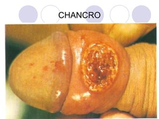 CHANCRO
 