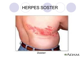 HERPES SOSTER
 