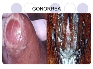 GONORREA
 