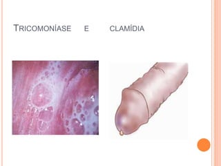 TRICOMONÍASE E CLAMÍDIA
 