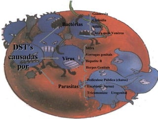 DST's causadas por Bactérias Gonorreia Clamídia Sífilis Úlcera mole Venérea Vírus SIDA Verrugas genitais Hepatite B Herpes Genitais Parasitas Pediculose Pública (chatos) Escabiose (Sarna) Tricomoníase  Urogenital 
