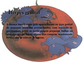 Herpes genital A doença manifesta-se pelo aparecimento na área genital de pequenas manchas avermelhadas, com sensação de queimadura, sobre as quais surgem pequenas bolhas ou vesículas que ao fim de alguns dias rompem, ocasionando feridas que se cobrem de crostas.  