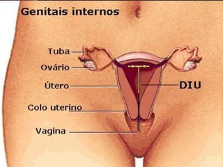 Dispositivo Intra-uterino
(DIU)
 
