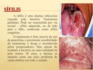 SÍFILIS
A sífilis é uma doença infecciosa
causada pela bactéria Treponema
pallidum. Pode ser transmitida por via
sexual - sífilis adquirida, ou da mãe
para o filho, conhecida como sífilis
congênita.
O tratamento é feito através do uso
da penicilina, a persistente sensibilidade
do treponema à droga é reconhecida
pelos pesquisadores. Mas apesar do
combate à bactéria ser uma realidade há
pelo menos 50 anos, a doença se
mantém como um sério problema de
saúde pública em todo o mundo.
 