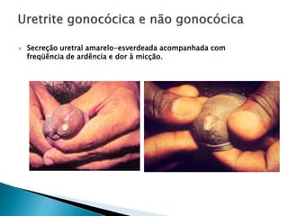  Secreção uretral amarelo-esverdeada acompanhada com
freqüência de ardência e dor à micção.
 