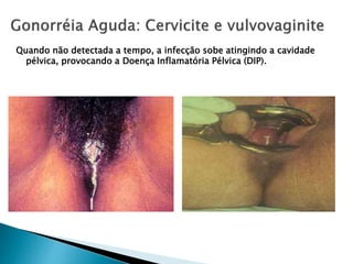 Quando não detectada a tempo, a infecção sobe atingindo a cavidade
pélvica, provocando a Doença Inflamatória Pélvica (DIP).
 