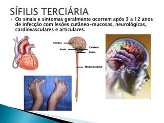  Os sinais e sintomas geralmente ocorrem após 3 a 12 anos
de infecção com lesões cutâneo-mucosas, neurológicas,
cardiovasculares e articulares.
 