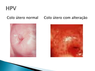 Colo útero normal Colo útero com alteração
 